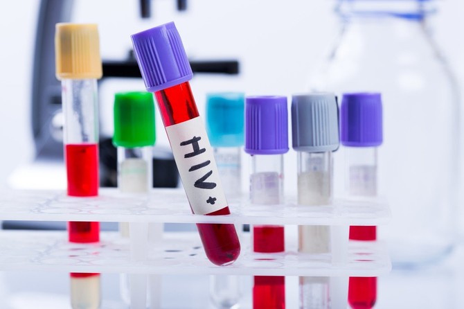  30 odsto novotkrivenih HIV infekcija registruje se u odmakloj fazi