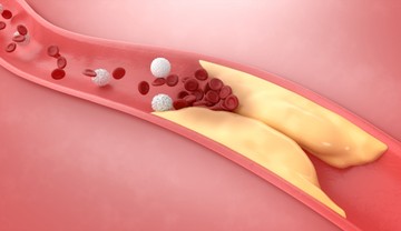 Az érelmeszesedés (arteriosclerosis) az ütőerek (artériák) belső falainak zsírok lerakódása miatt történő beszűkülésével és megkeményedésével járó betegség. Az erek térfogatának csökkenése következtében a vér nem tud akadálytalanul áramlani, ezáltal nő az artériák elzáródásának veszélye, ami stroke-hoz, szívinfarktushoz vagy a láb keringési zavaraihoz vezethet.