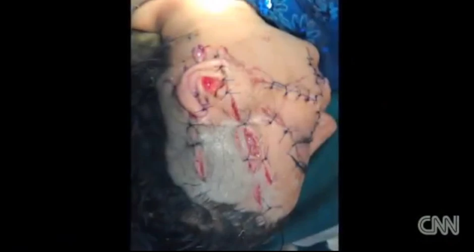 Glava Gul Mene neposredno nakon intervencije. Lobanja joj je bila otvorena,  mozak delimično prosut