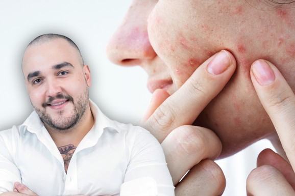 Akne kod odraslih nisu znak loše higijene: Dr Lukić objašnjava zašto se bubuljice javljaju, greške u nezi i kako sprečiti fleke i ožiljke