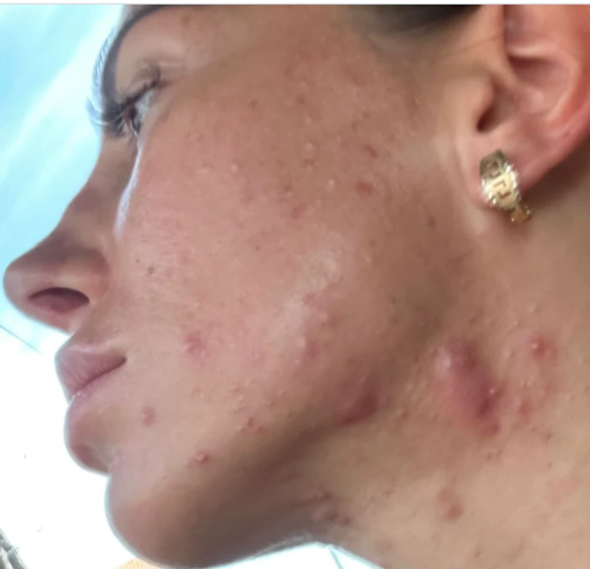  Cipka pokazala kako joj je izgledalo lice 