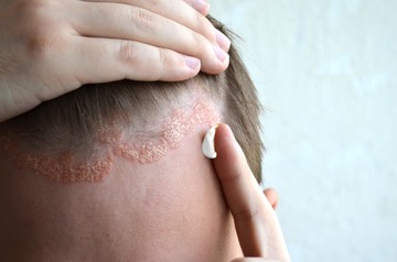 Pikkelysömör kezelése: 11 tipp, ami segít