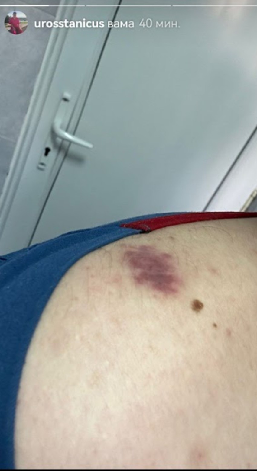 Povrede Uroša Stanića