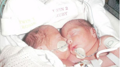 Pięciogodzinna operacja rozdzielenia bliźniaczek syjamskich zakończona sukcesem. Jak dziś wyglądają?