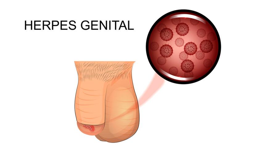 Nemi herpesz: kialakulása, tünetei, lefolyása és kezelése | EgészségKalauz