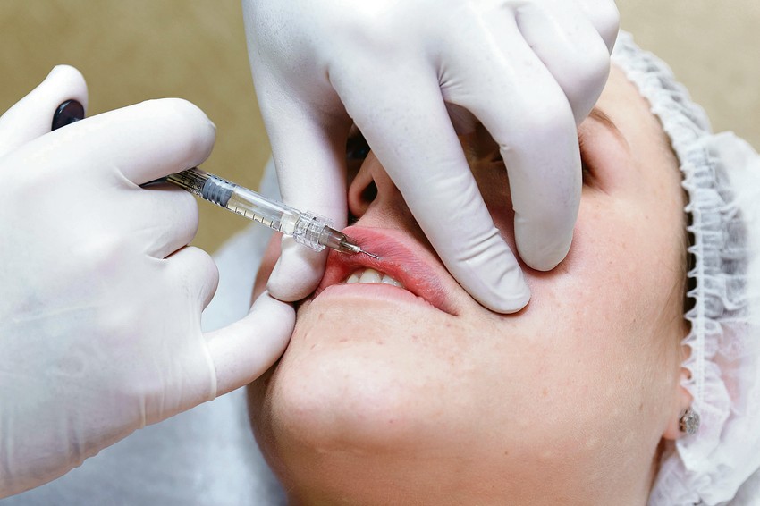 Korekcija uvećanje usana