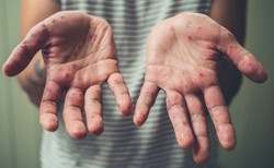 Coraz więcej chorych na odrę. Jak rozpoznać objawy?