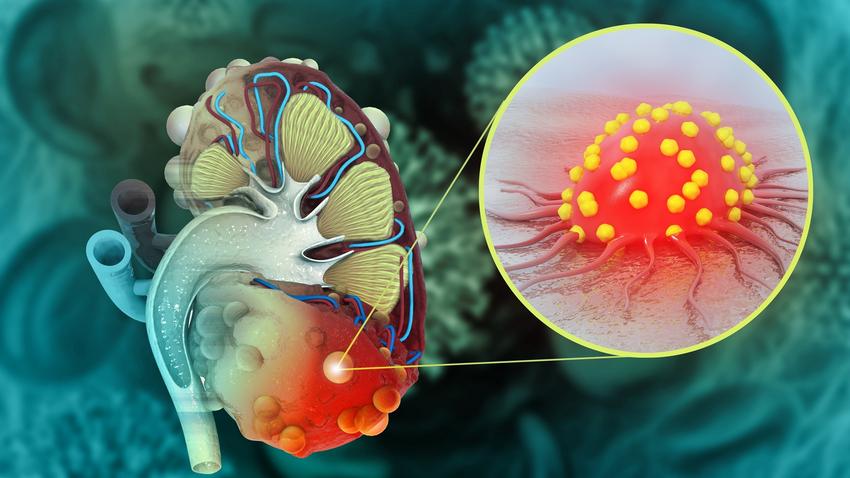 Áttétes veserák: ha ezeket a tüneteket észleli, már nagy a baj ...