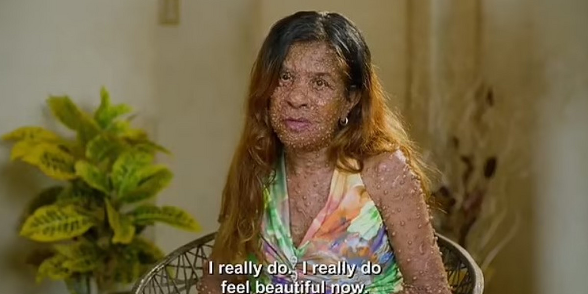 42-latka przez tysiące guzów porastających jej ciało nie mogła normalnie żyć.