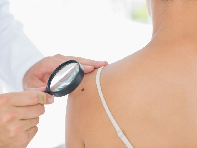 U proseku, oko 650 ljudi u našoj zemlji godišnje dobije dijagnozu melanoma, a oko 200 njih izgubi bitku protiv ove opake bolesti