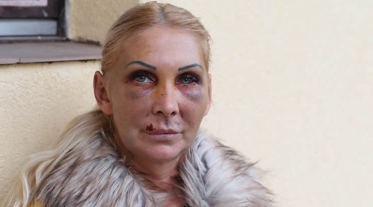 Orosz Bernadettet tavaly novemberben bántalmazta volt párja, a sérült arcáról készült fotók bejárták a médiát /Fotó: Pozsonyi Zita