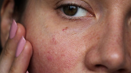 Pięć błędów, które pogarszają stan skóry wrażliwej i skłonnej do alergii