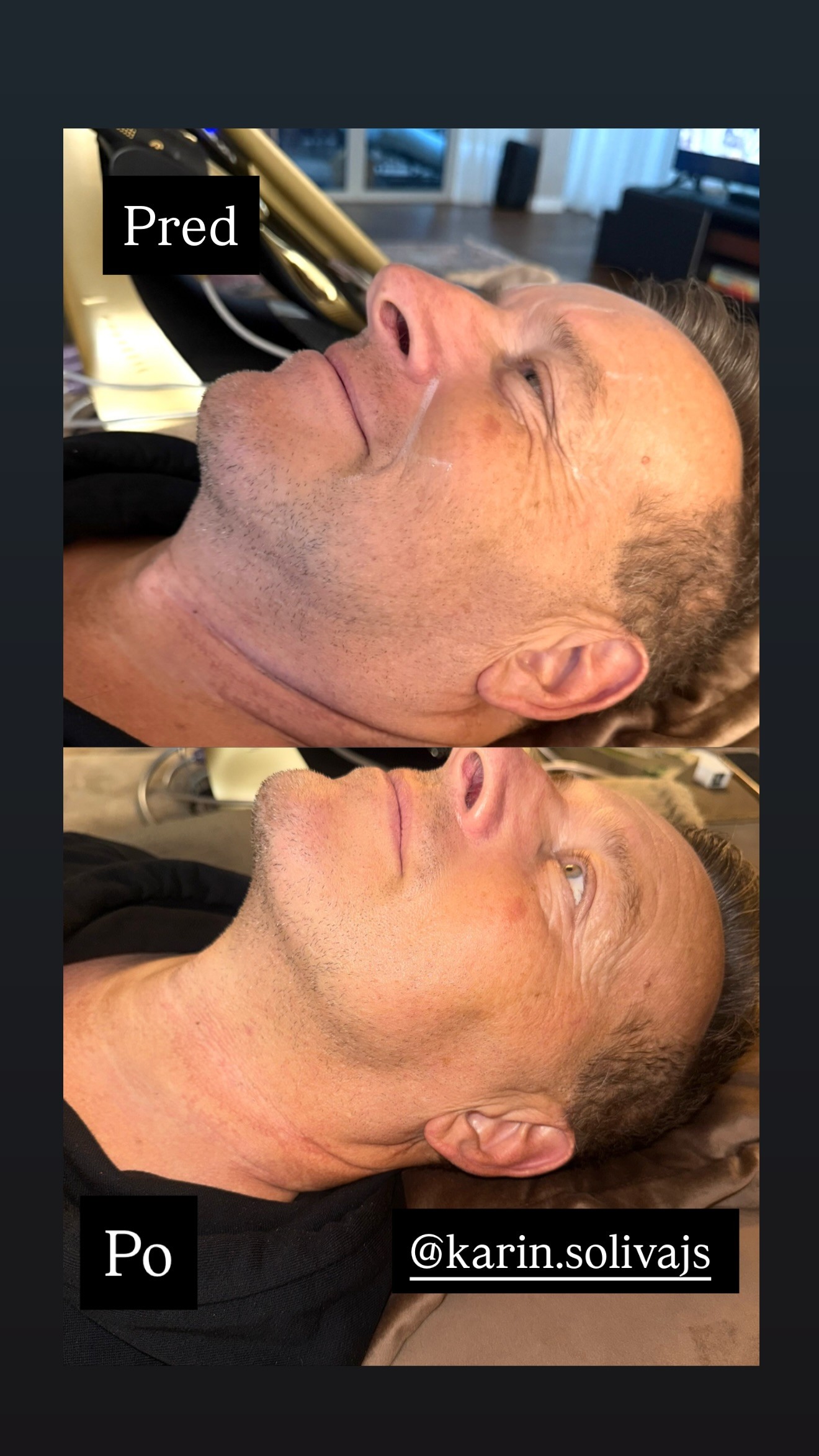 Boris Kollár absolvoval v októbri 2025 neinvazívne ošetrenie, ktoré využíva cielený ultrazvuk na omladenie pleti, lifting tváre a redukciu tuku.