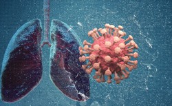 COVID-19 uszkodził mu płuca w 80 proc. Pacjent wrócił do zdrowia