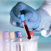 IR, PCOS, cukorbetegség: itt az új és egyszerűbb vizsgálat