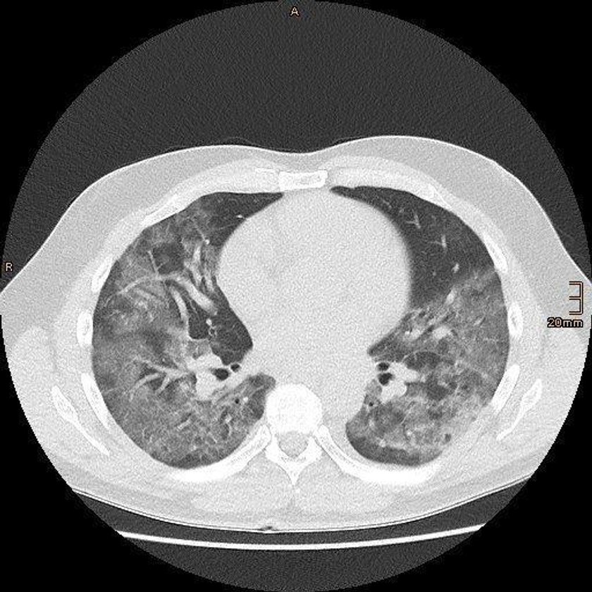 Koronawirus: respiratory niezbędne w zwalczaniu COVID-19?