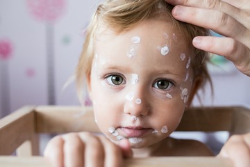 Majomhimlő: mennyire veszélyes gyermekeknél? Vakcinainfó - Az orvos válaszol