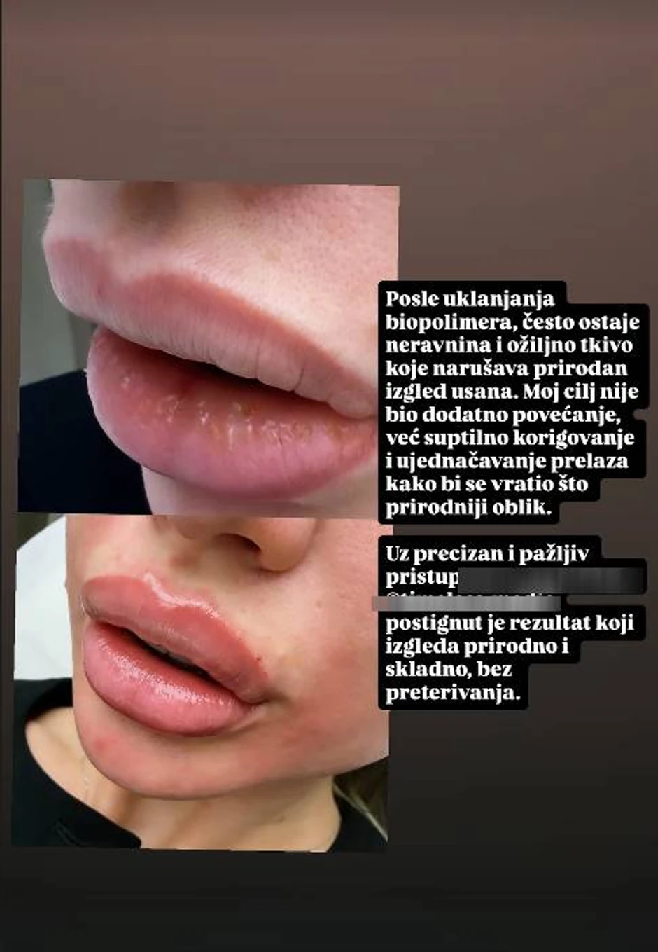 Milica Kemez skinula biopolimer