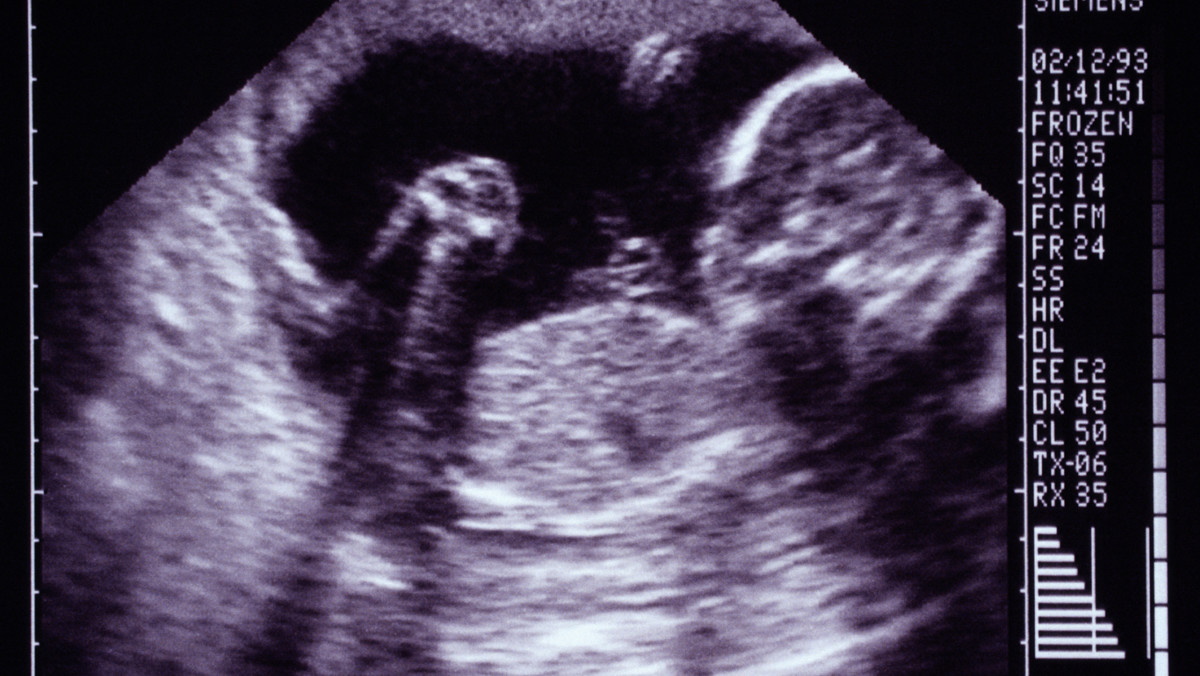 Hiszpańscy lekarze zastosowali nową technikę poszerzenia zastawki aortalnej u nienarodzonego dziecka w łonie matki. Stenoza aortalna jest przypadłością, która tylko w Hiszpanii dotyka czterdziestu płodów. Do niedawna taka diagnoza oznaczała, że ciąża nie zakończy się szczęśliwie.