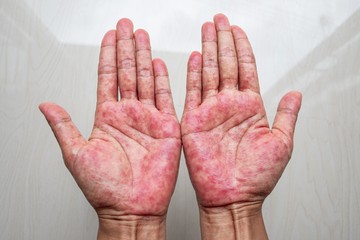 Az allergiás kontakt bőrgyulladás esetén nem ritka, hogy az érintett területen a bőr ödémás, duzzadt lesz. Az érintett bőrfelület ég, viszket, kivörösödik, hólyagosodik, lemezesen hámlik, esetenként megvastagodik, bereped.