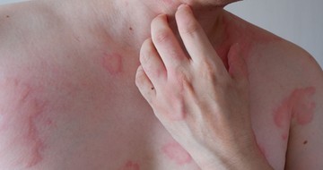 anafilaxia tünetek, jelek, két hullám, életveszélyes állapot