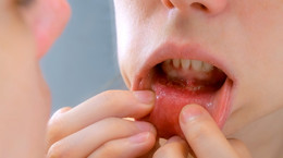 Opryszczkowe zapalenie jamy ustnej - objawy, leczenie, powikłania