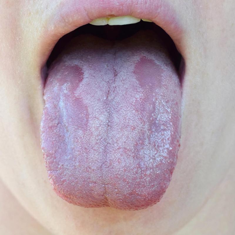 Grzybica Jamy Ustnej Rodzaje Przyczyny Objawy Leczenie