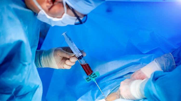 csontvelő-transzplantáció hematopoetikus őssejt-transzplantáció leírás