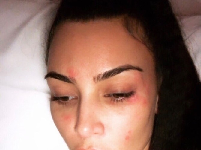 Kim Kardašijan ne krije svoju psorijazu