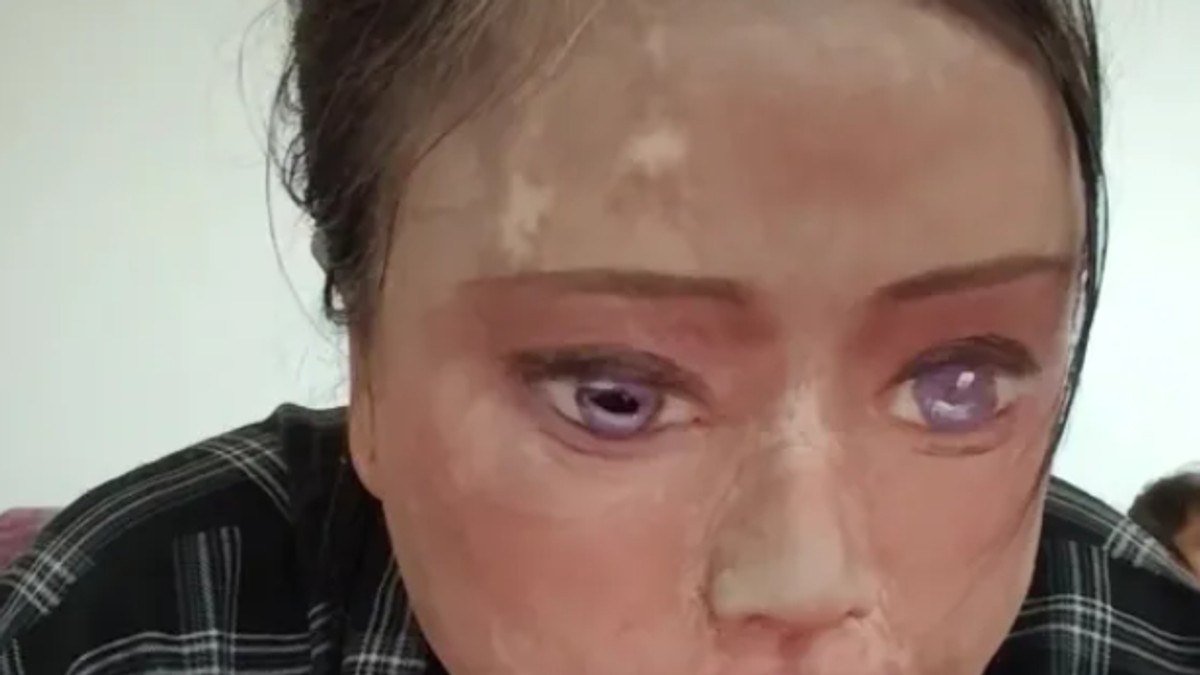 "Oči crtam šminkom jer svoje više nemam": Ispovest žene koju je muž polio kiselinom