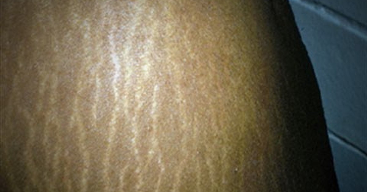 How to get rid stretch marks with coconut oil - Vimarsana News