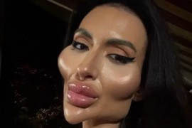 Anastasija ima NAJVEĆE OBRAZE NA SVETU I GIGANTSKA USTA: Pre operacija OVAKO IZGLEDALA i svi se čude šta je uradila od sebe