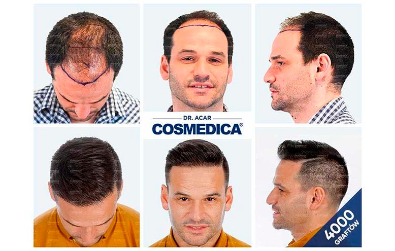 przeszczep włosów, turcja