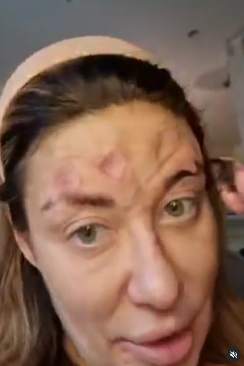 Ana Nikolić sa kožnim problemima