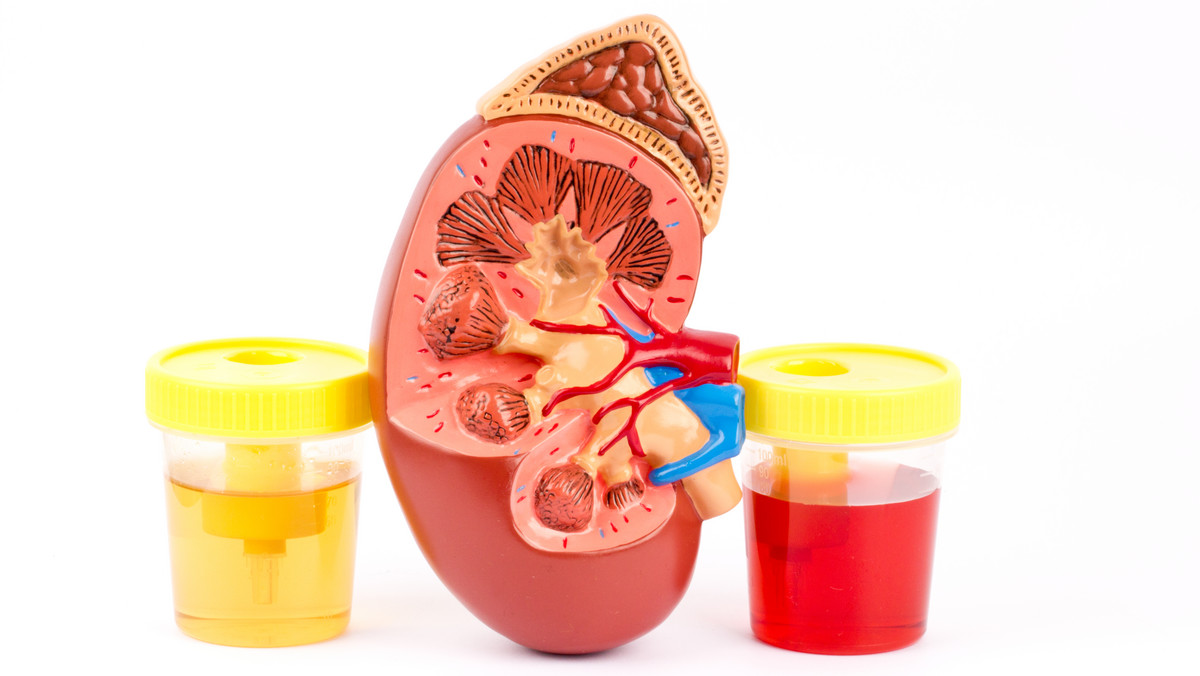 Krwiomocz, czyli tak zwana hematuria, to symptom, który może zwiastować różne choroby lub schorzenia. Jego przyczyną może być przyjmowanie leków hamujących krzepnięcie krwi, jak również zaburzenia ze strony układu płciowego lub moczowego. Jeżeli tylko zauważymy krew w moczu, należy udać się do lekarza i zapytać, co to oznacza.