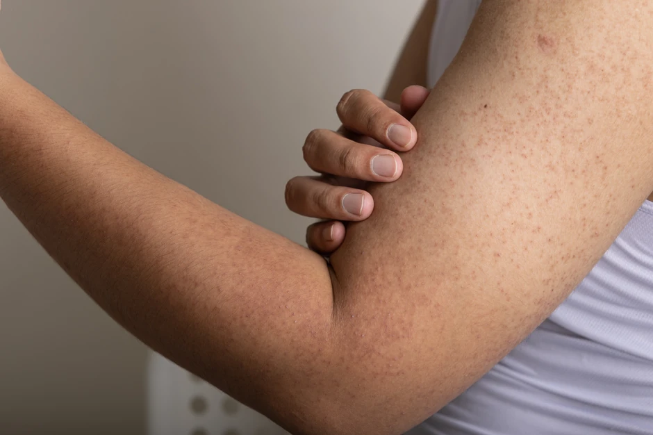 Keratoza pilaris, poznata kao "guščja koža", izaziva hrapave, crvene ili bele kvržice na koži