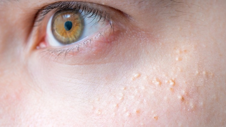 milium, gríz, bőrprobléma