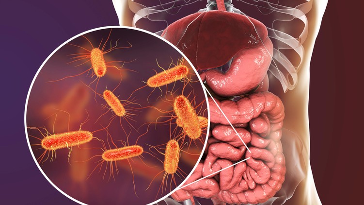 stroke, mikrobiom, baktériumok daganat, tumor laboratóriumi vizsgálatok