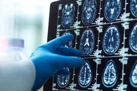 Co powoduje rozwój choroby Alzheimera? "Kolejny istotny element układanki"