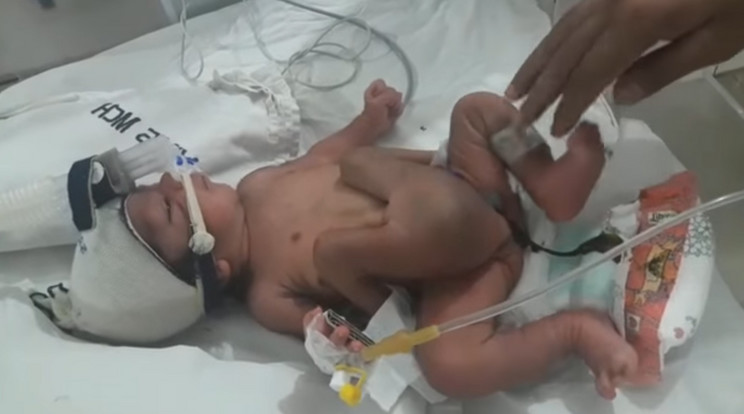Négy lábbal született a kisbaba / Fotó: YouTube