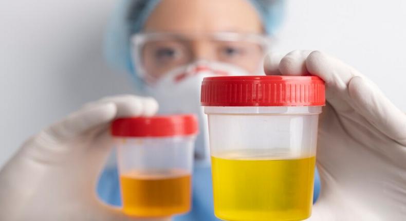 What's normal or not about your urine colour [MetropolisHealthcare]