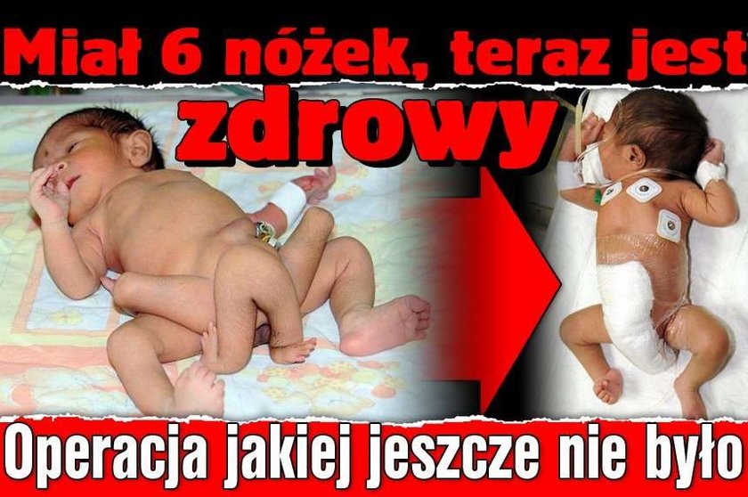 Sześcionogi chłopiec już po operacji