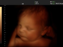 Jakie wady płodu można wykryć na USG?