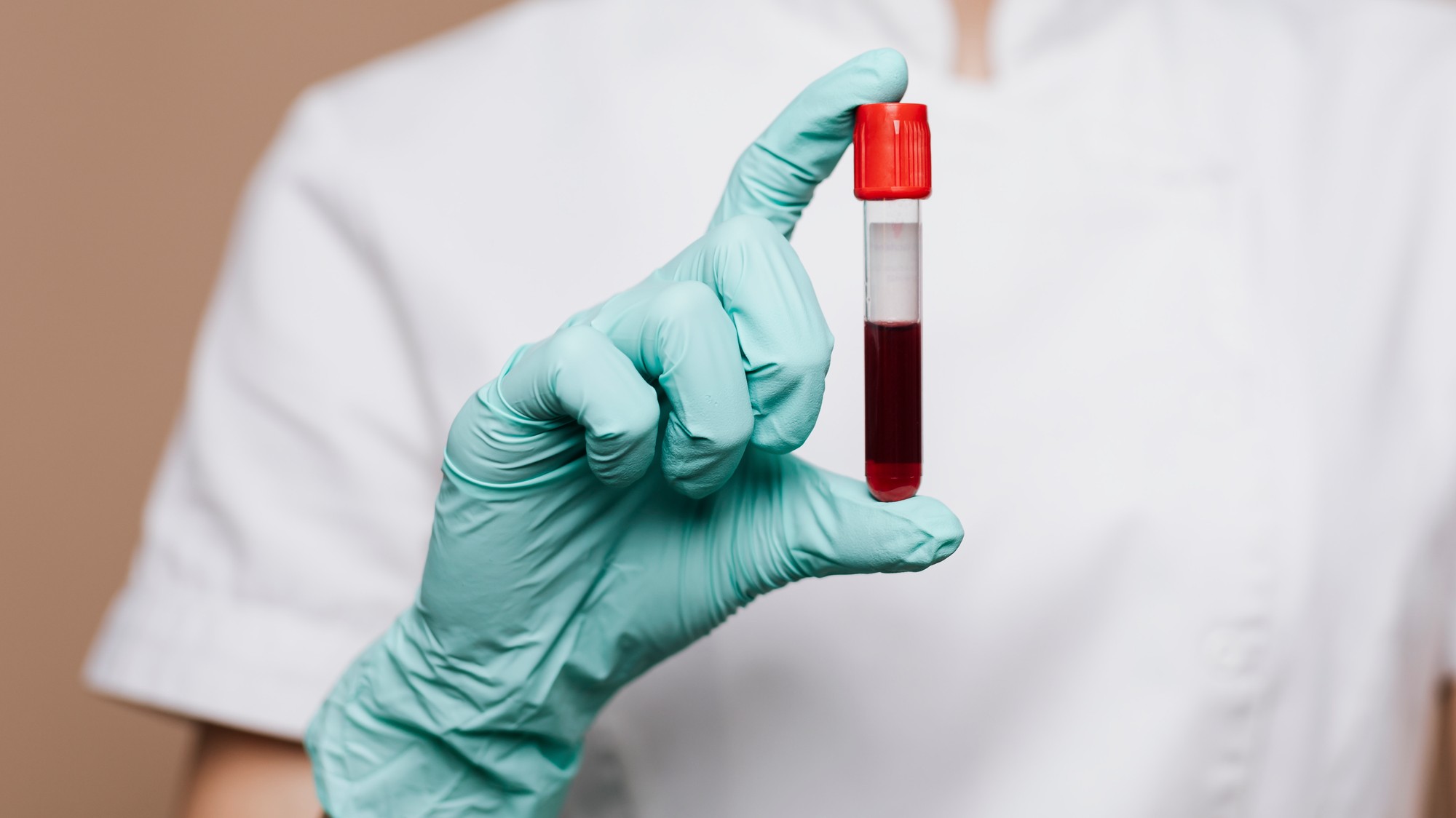 Alzheimerovu chorobu môže odhaliť krvný test.