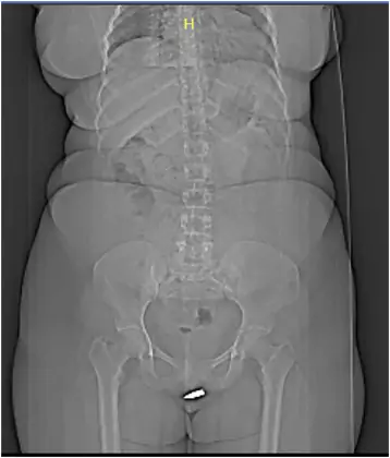 Zdjęcie rentgenowskie, które wykonano 24-latce. Widoczny ołowiany nabój / International Journal of Surgery Case Reports