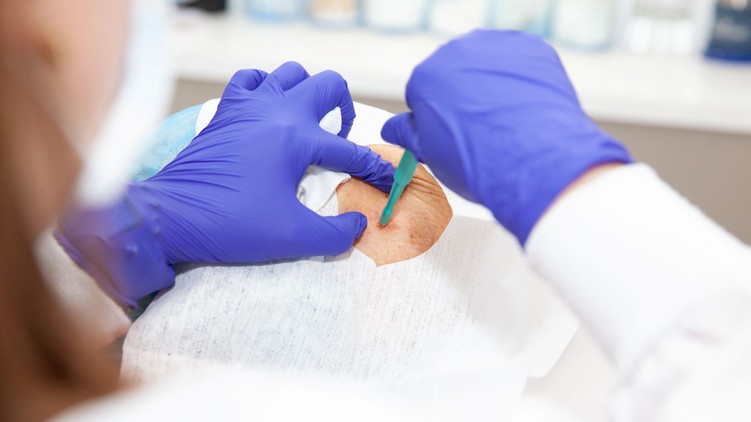 bőrbiopszia mikor kell hogyan zajlik