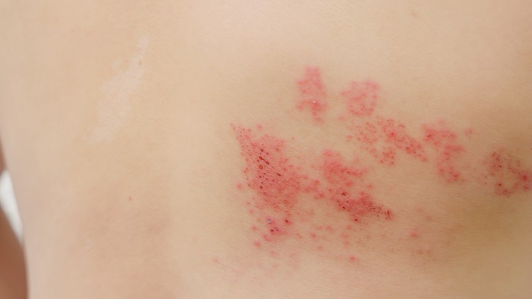 Övsömör (Herpes varicella zoster)