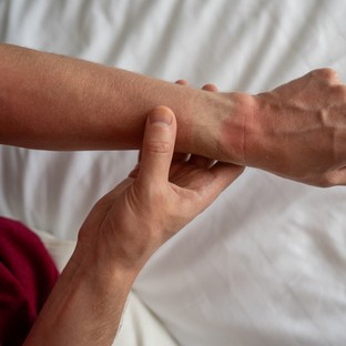 Napallergia: ezt teheti, ha a bőre nem bírja a napfényt!