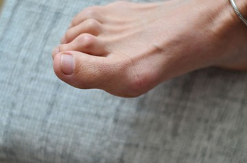 Ezzel a 4 módszerrel kerülheti el a kalapácsujj műtétet