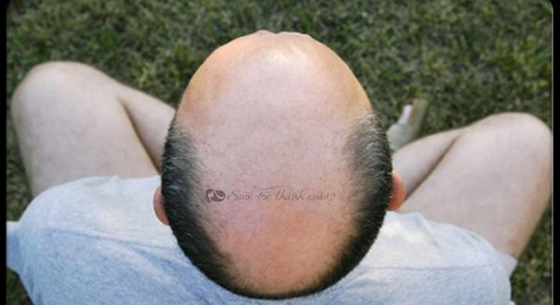 Man with bald head